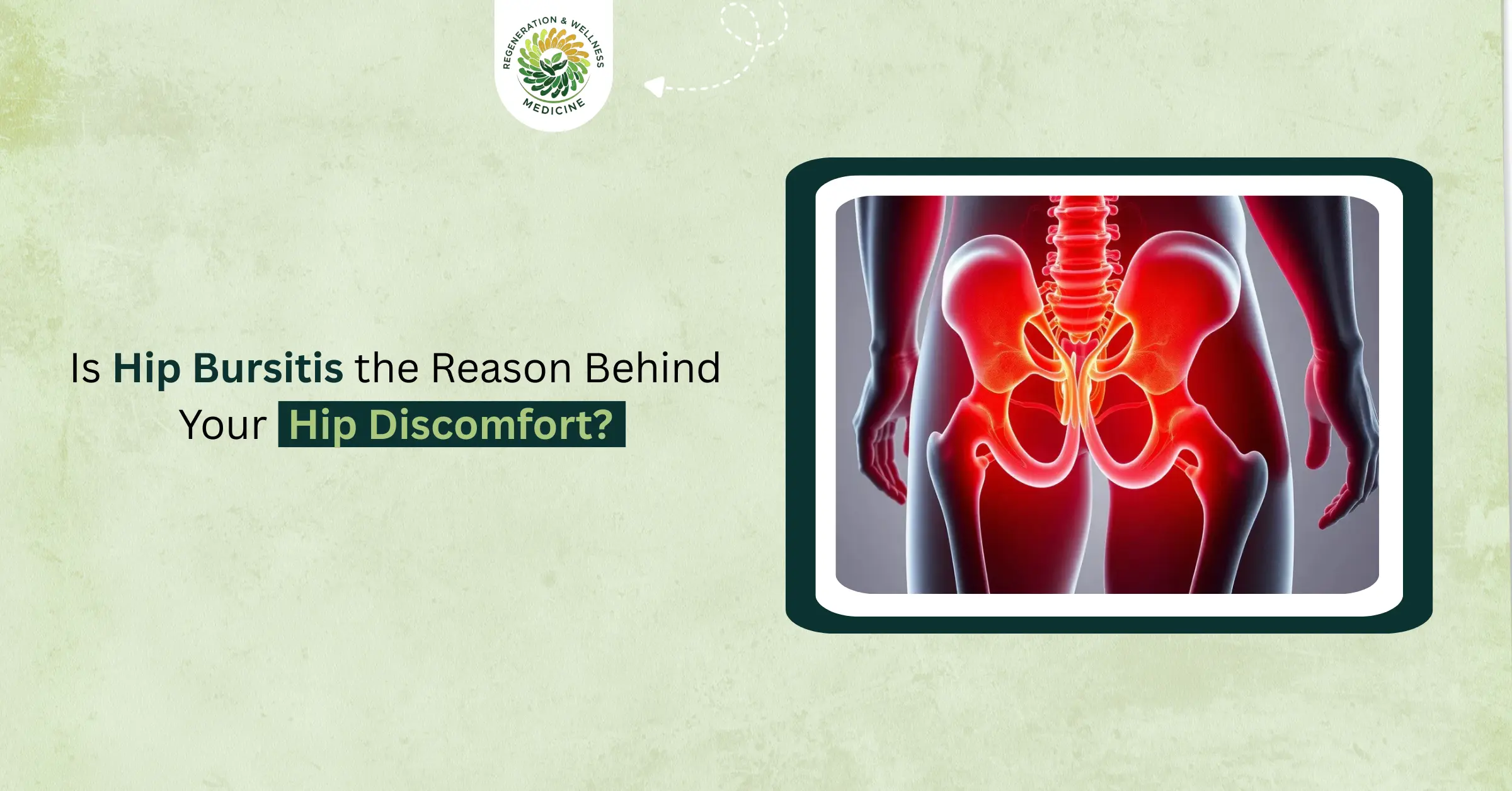 Is Hip Bursitis the Reason Behind Your Hip Discomfort